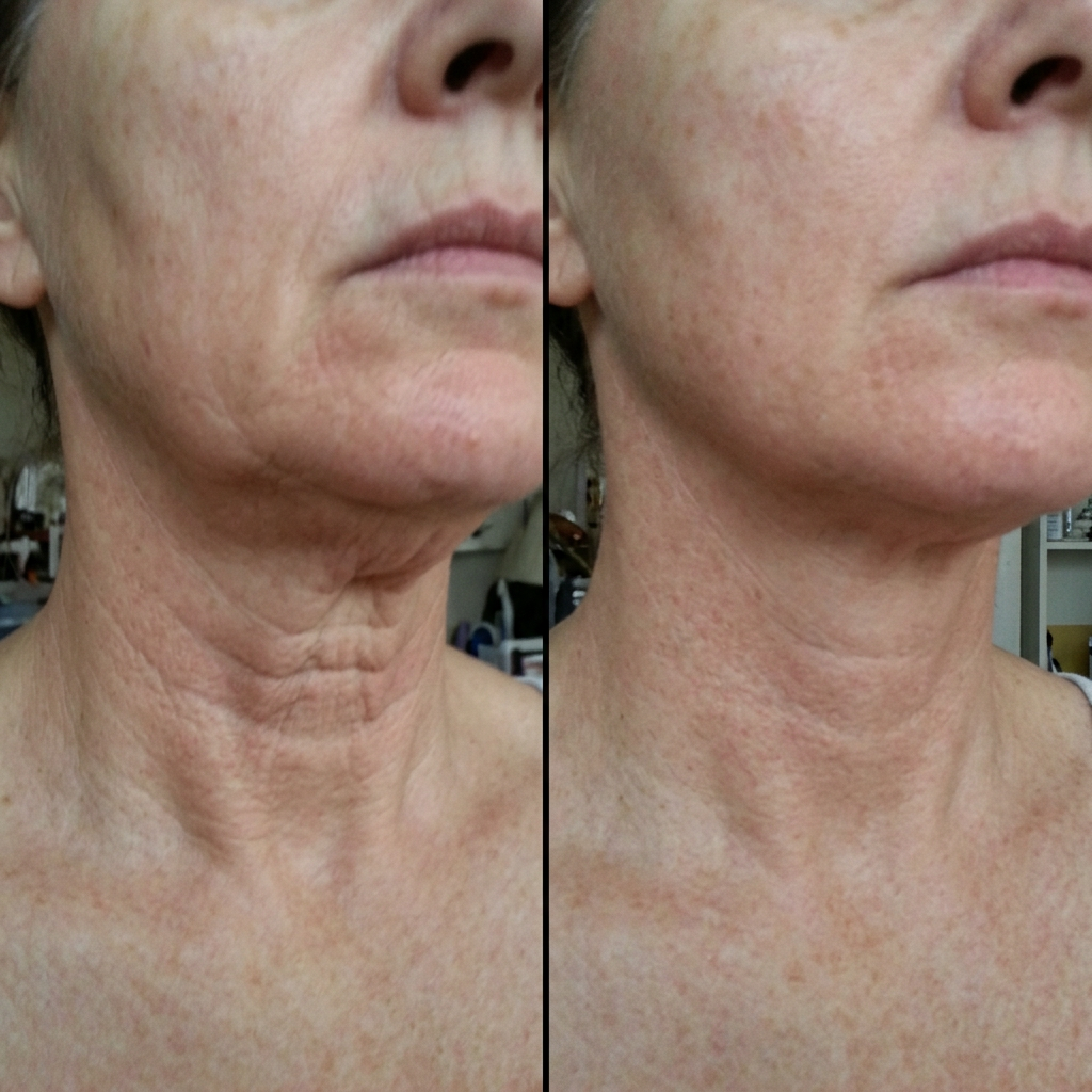 Susan's results with the Leopard Luxe mask